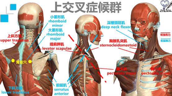 上交叉症候群