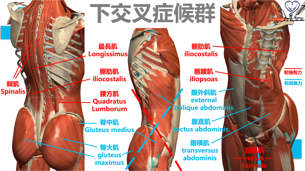 下交叉症候群