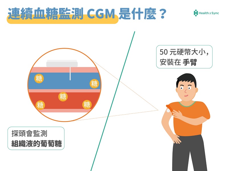 連續血糖監測CGM安裝